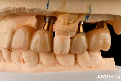 China Restauración de los dientes faltantes Implante de corona y puente seguro para oral con ajuste preciso en venta