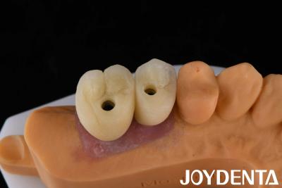 China Implante de corona y puente de porcelana La solución definitiva para la restauración de los dientes perdidos en venta