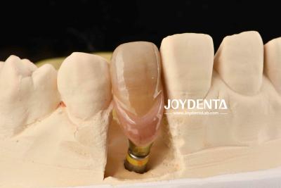 Cina 0° Angolazione Abutamenti dentali finiti 1,5 mm Filtro di filo Superficie lucidata in vendita