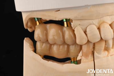 China 4.5 mm Hoogte Gepolijst Interne Hex Tandheelkundige Implantaten Abutments V-vorm Schroef behouden Te koop