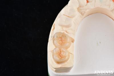 China Natural Looking Dental Zirconia Inlays And Onlays High Esthetically Precise Fit for sale