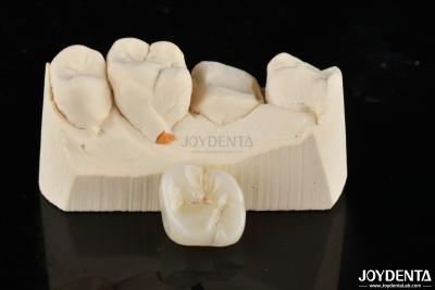 China Inlays e Onlays de Zirconia Restaurações feitas sob medida para um ajuste e estética incomparáveis à venda