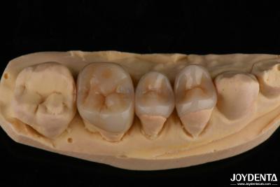 China Aparência natural Emax Inlay Onlay Restauração dental duradoura 0,5 mm 1 mm 1,5 mm espessura à venda