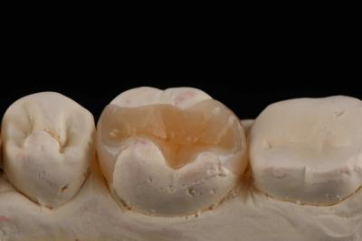 China E Max Material Inlay e Onlay na Odontologia Restauração Estética Durável à venda