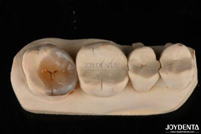 China Enlaces y enlaces dentales personalizados de aspecto natural para la restauración dental en venta