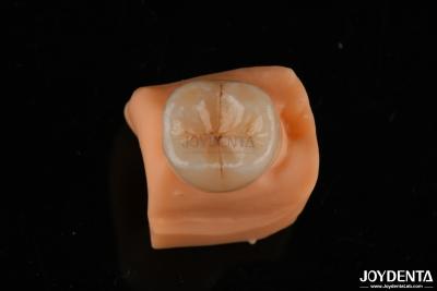 China 0.5mm resistente a manchas Emax Inlay Onlay adequado para restaurações dentárias à venda