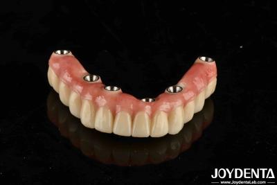 China Puente de implantes dentales de titanio malo que combina técnicas tradicionales y modernas en venta