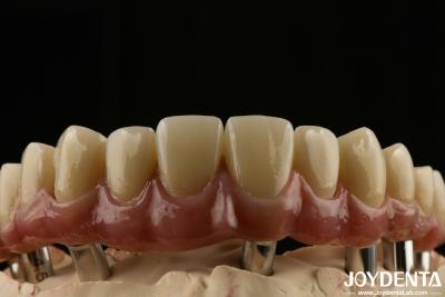 China Puente híbrido dental de titanio Malong de larga duración ajustado para ajustarse baja densidad en venta