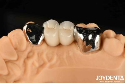 China Metallic Dental Maryland Bonded Bridge Good Remediation For Oral Clinical Repair for sale