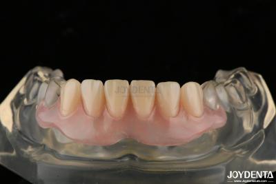 China Personalized Invisible Denture Finished With Advanced Tooth Arrangement Technology for sale