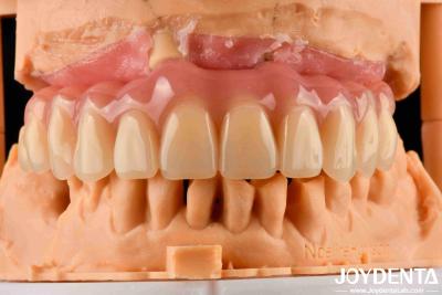 China Prótese dentária acrílica com tecnologia de arranjo dentário à venda