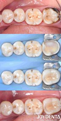 China Customizable Dental Porcelain Inlay Restoration For Perfectly Fitted Teeth Repair for sale