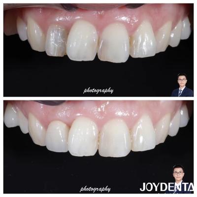 China Aesthetics Translucency Zirconia Crowns Natural Looking High Fracture Resistance for sale