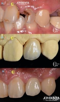 China Lifelike Tooth Appearance Zirconia Bridges Dental Restoration Wear Resistant Customized for sale