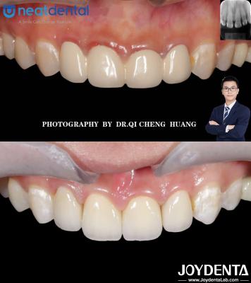 China High Translucency Multilayer Zirconia Crown For Anterior Posterior Teeth Crack Resistant for sale