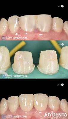 Cina Denti perfettamente adattati Coroane dentali circonia con sistemi CAD CAM per la produzione di precisione in vendita