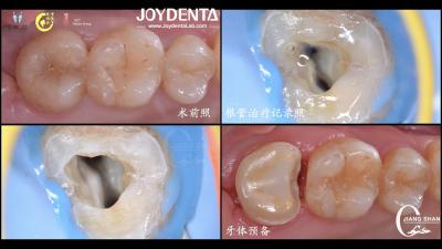 Cina Durabile Infisso di ceramica dentale dall'aspetto naturale Precise Fit Alta compatibilità in vendita