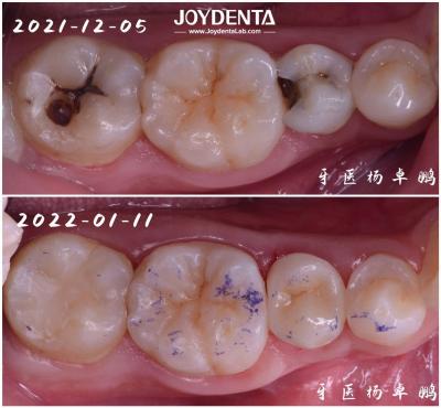 China High Durability Inlay Dental Restoration For Damaged Tooth Various Sizes Available for sale