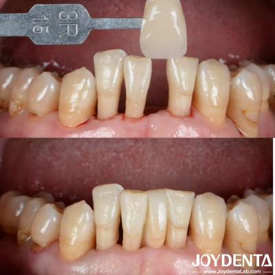 China Natural Shape Ceramic Maryland Bonded Bridge Dental Restorations Excellent Aesthetics for sale