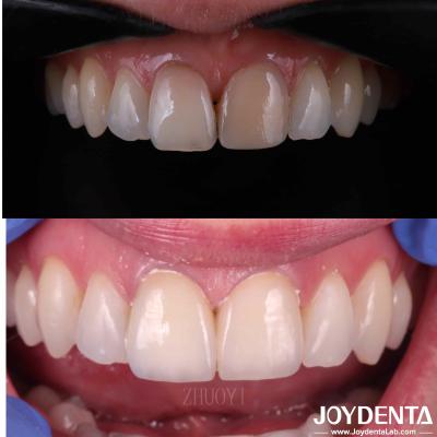 China Smooth Surface Dental Veneers For Crooked Teeth , Custom Cosmetic Porcelain Veneers for sale