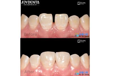 China Secure Fit Porcelain Veneers Dental Treatment Composite Resin Veneers Stain Resistant for sale