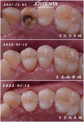 China Accurate Fit Dental Porcelain Inlay Damaged Teeth Restoration For Adults And Children for sale