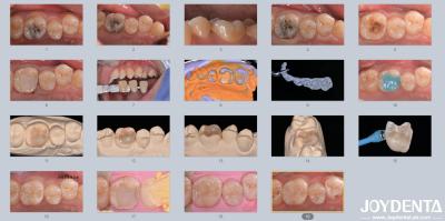 Cina Adulti Bambini Infissi dentali in ceramica di porcellana per denti danneggiati in vendita