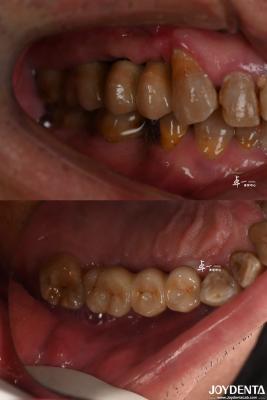 Cina Implantazione dentale a superficie ruvida per materiale in titanio a livello osseo sottocrestato in vendita