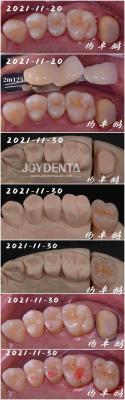 Cina Procedura dentale in legno di porcellana senza cuciture Forma personalizzabile per la riparazione dei denti in vendita