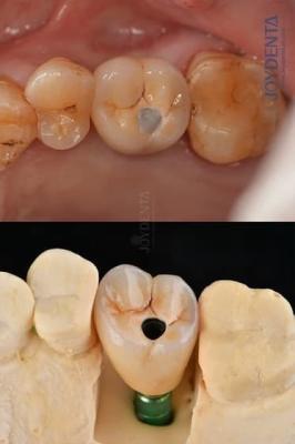 Cina Impianti dentali in titanio a arco pieno Piattaforma protesica da 4,1 mm per una durata eccezionale in vendita