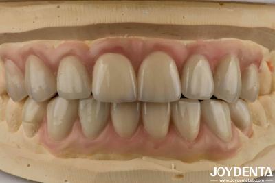 China High Translucency Emax Cosmetic Dentistry Veneers High Aesthetics Ultra Thin for sale