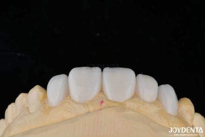 China Aanpassing Porselein Materiaal Emax Tanden veneers voor hoge esthetiek binding Te koop