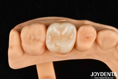 China Hoge slijtvastheid Tandheelkundig volledig Zirconia Hoge sterkte Volledige contour Zirconia brug Te koop