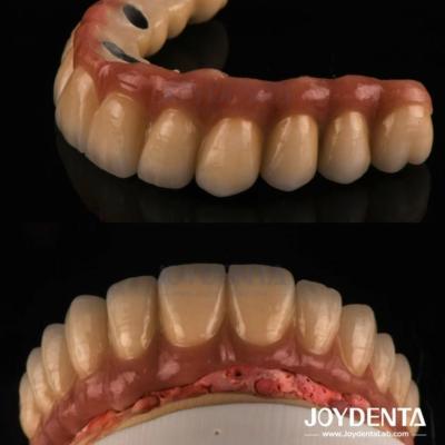 China Fundir y fresar PFM Corona de dientes, restauraciones dentales Corona de metal fundido de porcelana en venta