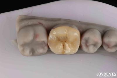 China Preparação mínima para restauração dentária danificada à venda