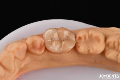 China Alta durabilidad Dental Inlay Onlay Compuesto Apariencia natural en venta