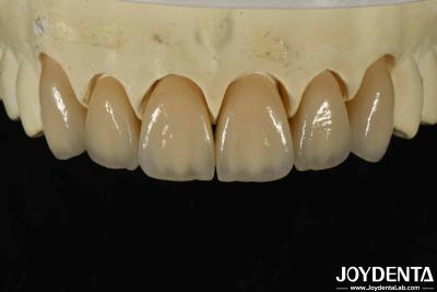 Cina eccellente biocompatibilità zirconia stratificata con elevata estetica e densità 6,0-6,1 g/cm3 in vendita