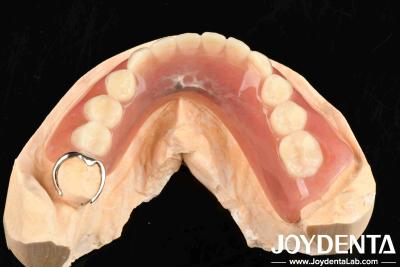 China Metals And Resins Framework Set Up Teeth Finish For Stable Oral Structure In Dental Configuration for sale