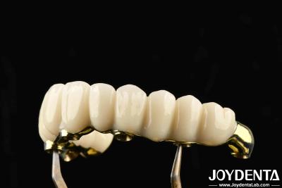 Cina Confortevole da indossare Ponte ibrida in zirconia Ti-Bar ripristina la funzione masticatrice compatibile con denti e gengive naturali in vendita