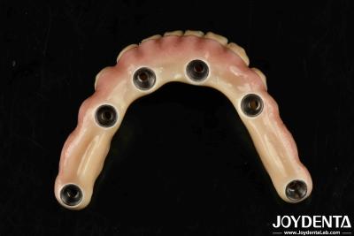 China Durable Dental Aesthetic Titanium Malong Hybrid Bridge For Care for sale