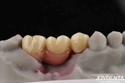 China Customizable Dental Implant Supported Bridge And Crown For Dental Implants for sale