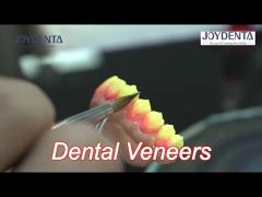 long-lasting and stain resistant dental veneers with personalized shades for natural teeth