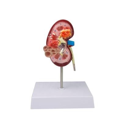 China Medical School Plastic Kidney Anatomical Human Model, Pathology Renal Kidney Stone Model, Urinary Tract Model for sale