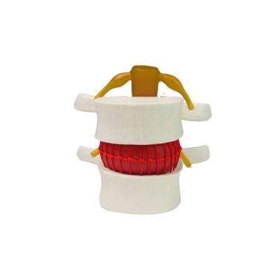 China Medical school lumbar disc herniation demonstration spine model, spinal pathology model, lumbar vertebrae with herniated disc for sale