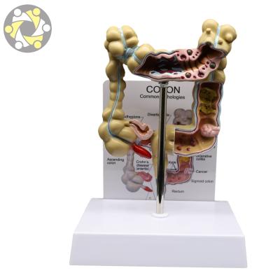 China Education advanced diseased large intestines model for education for sale