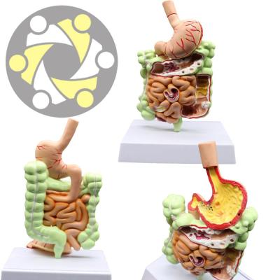 China Education Plastic Sick Abnormal Structure Model Of Digestive System Anatomy for sale