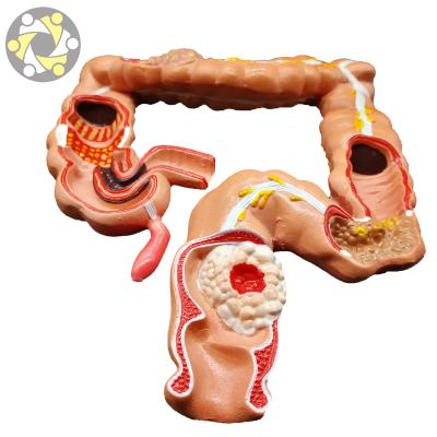 China Education Hospital Medical Colon Model Science Common Disease Subject Model for sale