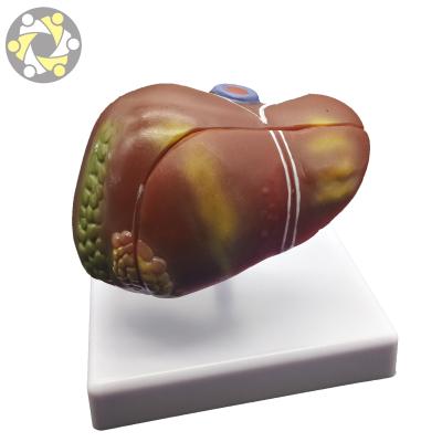 China Medical Teaching Model Liver Diseased Model Education Pathology Anatomy Liver Cirrhosis for sale