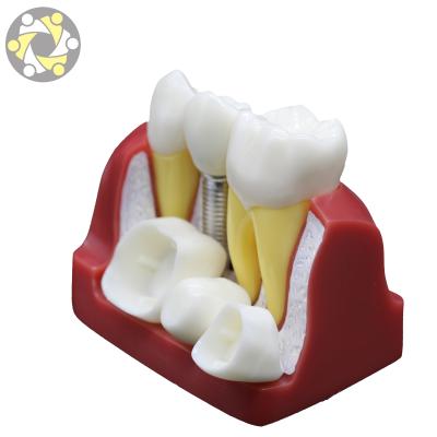 China Medical Model Dental Implants Education Medical Science Education Restoration Model for sale