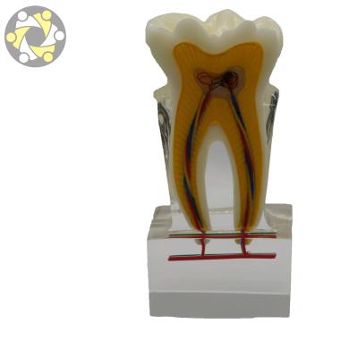 China Transparent Molar Tooth Decay Dental Caries Model Education Anatomical Model for sale